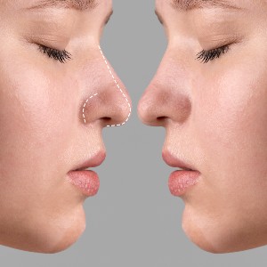 La evolución de las técnicas de rinoplastia en la última década